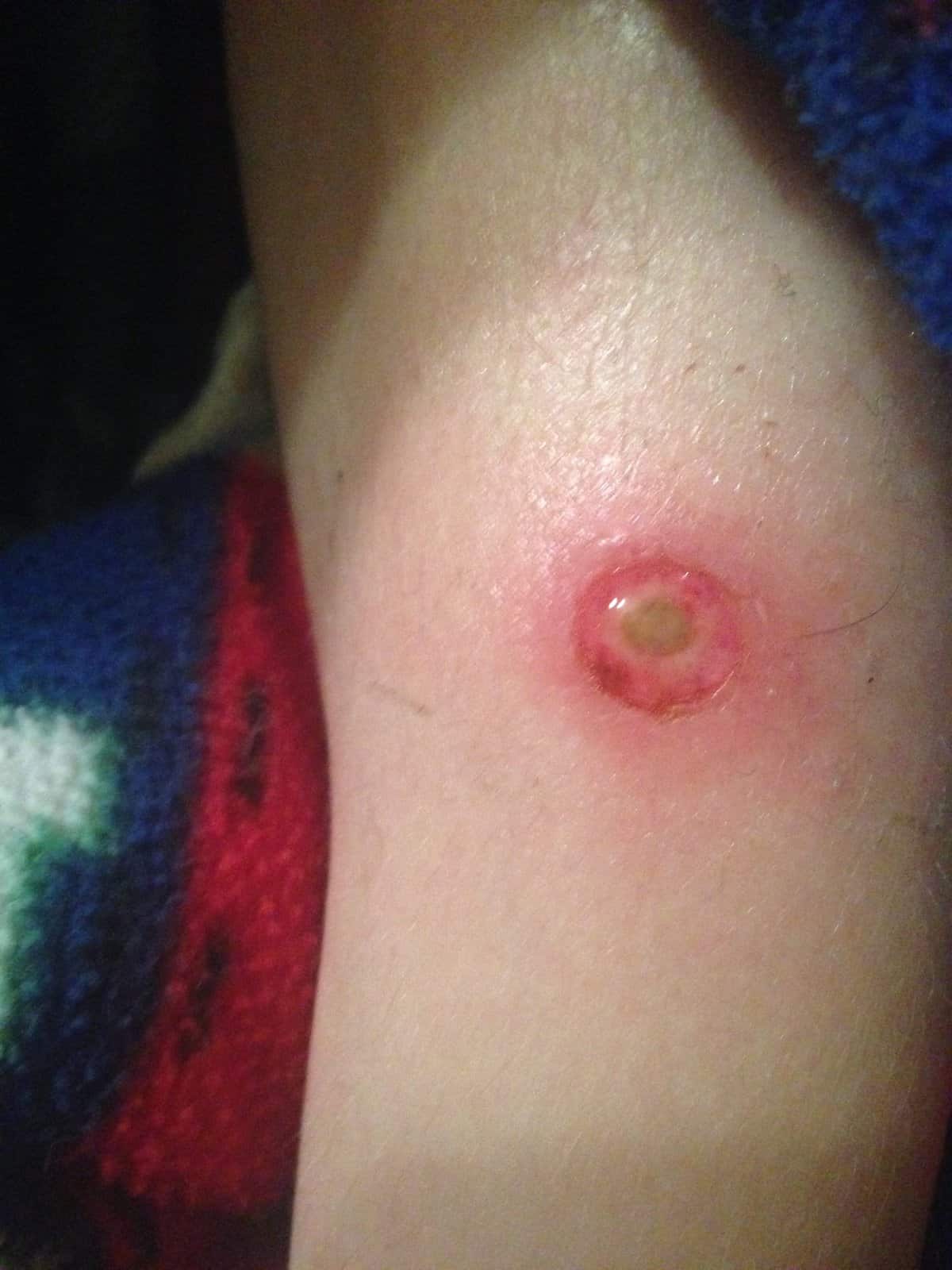 Brown Recluse Spider Bite! - Ridge Haven Homestead